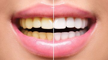 كيف تتخلص من الأسنان الصفراء: إليك أبرز الطرق المنزلية لتبييض الأسنان